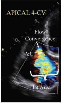 vena contracta Limited correlation between vena contracta width by 2D color Doppler and 3D assessment of ERO Always