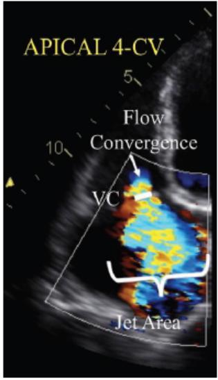 Echo assessment of TR ( II VC) Limited correlation between vena contracta width by 2D color Doppler and 3D assessment of ERO