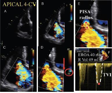 Echo assessment of TR (III- PISA) PISA radius is measured at midsystole ( using the first aliasing), Severe TR : > 9mm at a Nyquist limit of 28 cm/s, ERO > 40mm2 75 mm2, RV> 45ml- 60ml Leaflets that