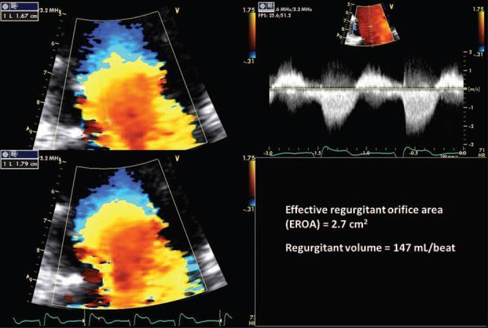 Quantification of regurgitation severity by PISA method.