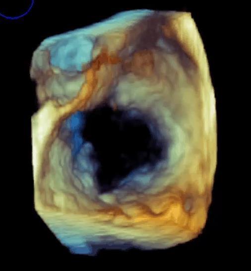 Posterior Septal Right