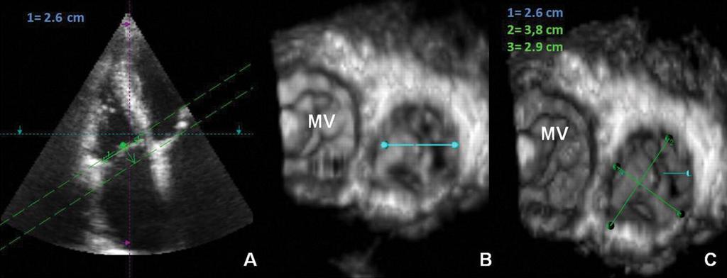 Comparison of tricuspid annulus diameter measurements by