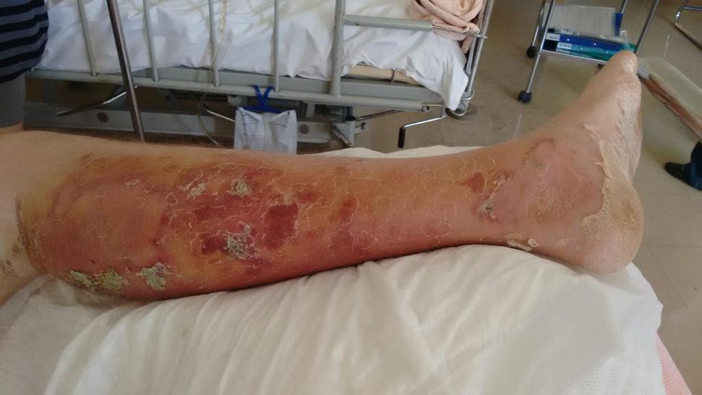 20 εκέξεο κεηά ηελ ΑΠΟΚΛΙΜΑΚΩΗ ζε: