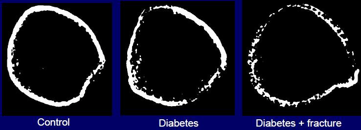 RESOLUTION pqct J Clin Endocrinol Metab