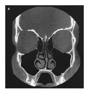 CT Scans of the Paranasal Sinuses.