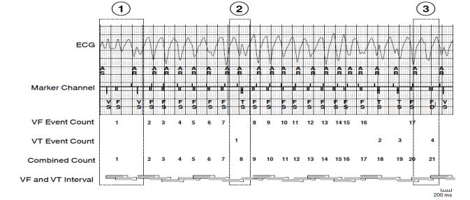 Arrhythmic Syncope Before Defibrillation 70-year-old man Old anterior MI, LVEF=35% CAD 3 vessel disease CABG with 3 vein grafts ICD (2012) for primary prevention (PVCs, Inducible VT) Angina in