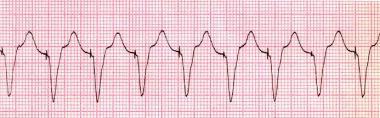 increment Higher probability for VT induction Need for