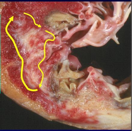 Catheter Ablation: A useful