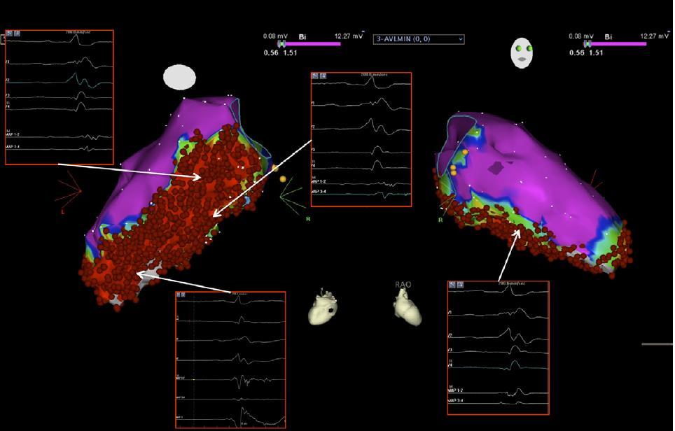 (82% in Endocardial Substrate Ablation and 88% in Homogenization of