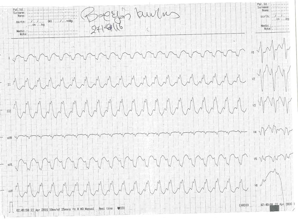 65-years-old man with VHD and old anterior MI