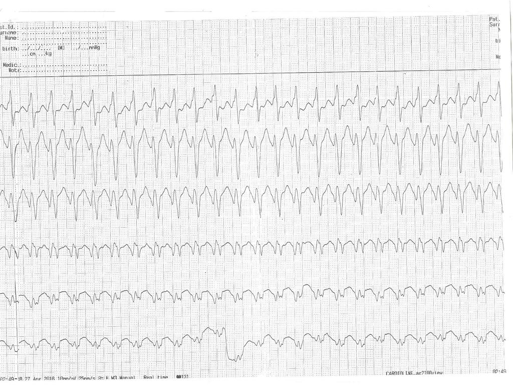 CRT-D LVEF: 15-20% Sustain monomorphic VT