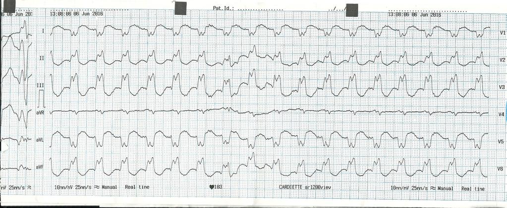 65-years-old man with VHD and old anterior MI Prosthetic