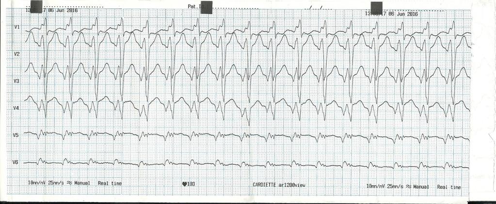 monomorphic VT multiple shock and ATP Treatment with amiodarone