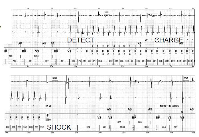 ICD shocks may have a negative impact on patients' quality of life ICD shocks are associated with higher mortality ICD shocks may be a marker of more advanced heart