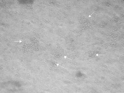 كنترل شده است. تصوير شماره 1- نماي ميكروسكوپي كلنيهاي اريتروي يدي كشت مغز استخوان در گروه كنترل بزرگنمايي 40 برابر.