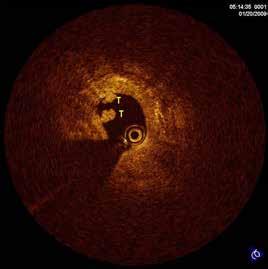 ΑΠΕΙΚΟΝΙΣΤΙΚΕΣ ΤΕΧΝΙΚΕΣ Οι μετρήσεις που κάνουμε με τη χρήση της OCT κατά την PCI είναι ό,τι και με το ενδοστεφανιαίο υπερηχογράφημα με τη διαφορά ότι λόγω της περιορισμένης διεισδυτικής ικανότητας