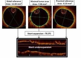 Μέτρηση ελάχιστης επιφάνειας της ενδοπρόθεσης (minimum lumen area), της επιφάνειας του αυλού εγγύς (proximal reference area) και άπω(distal reference area) της ενδοπρόθεσης, υπολογισμός της έκπτυξης