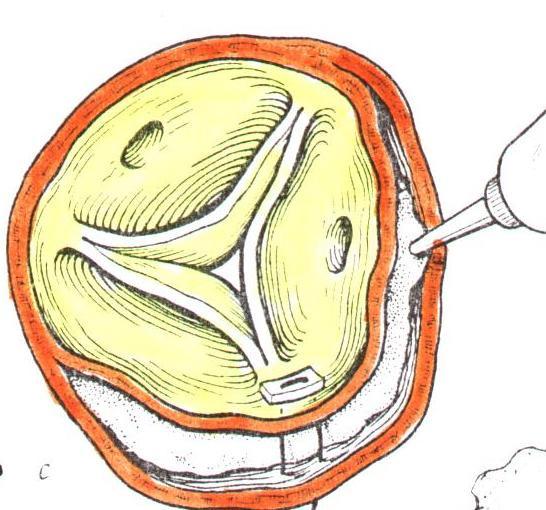 radacinii aortice disecate cu conduit graft,tehnica Bental, conduit