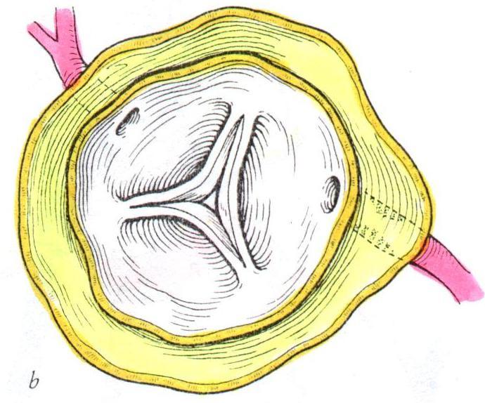 Surjet la nivelul segmentului distal.