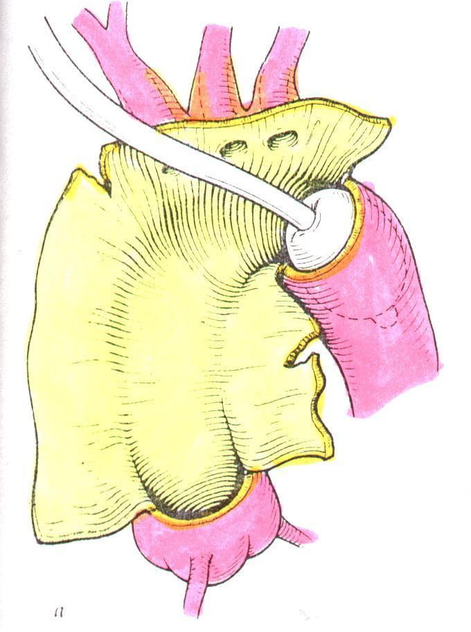 Disectia aortica acuta cu Leziuni coronariene asociate se asociaza si Bypass-ul aortocoronarian (Fig 9.) Fig 9.
