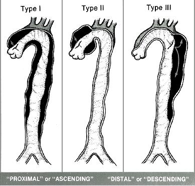 elasticitatii aortei, depozitele de mucopolizaharide din peretii aortei si dezvoltarea de anevrisme si disectii. b) Bolile castigate.
