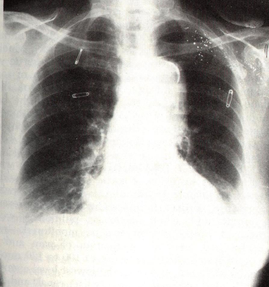 In cazul pacientilor instabili hemodinamic, atitudinea imediata este diferita, pacientul fiind intubat si ventilat, se instaleaza o linie venoasa centrala, linie de monitorizare a presiunii arteriale