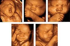 Ultrasonografia 10 Progresele tehnologice au permis dezvoltarea ecografiei 3D în care reflexia