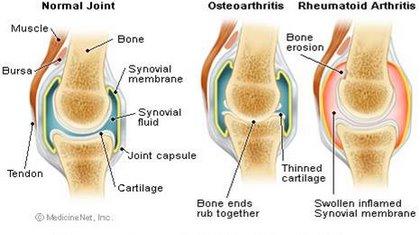 Anatomy of a Joint CARTILAGE: αρθρικός χόνδρος, είναι ένας ελαστικός, λείος ιστός, ο οποίος καλύπτει τα οστά που έρχονται σε επαφή σε μία άρθρωση και επιτρέπει την ομαλή, με ελάχιστη τριβή, κίνηση