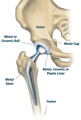 The Metal Stem Hip replacement is a surgical