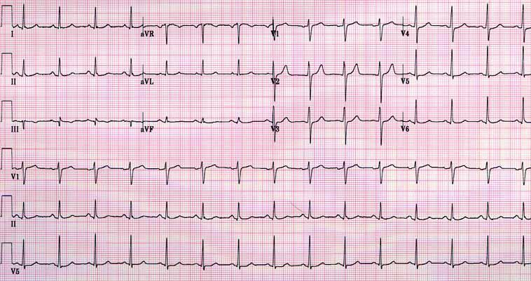 Ηλεκτροκαρδιογράφημα (ECG) Γίνεται για διάφορους λόγους για καλό και για κακό όσοι είναι πάνω από 40 ετών πόνο στο στήθος ταχυπαλμία φάρμακα που επηρεάζουν την καρδιά όσοι έχουν βηματοδότη (για να