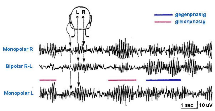 Ηλεκτροεγκεφαλογράφημα (EEG) Το EEG είναι μια διαφορά δυναμικού μεταξύ δύο ηλεκτροδίων Unipolar measurement (indifferential right ear electrode ) Bipolar measurement Εάν ένα ηλεκτρόδιο είναι σιωπηλό,