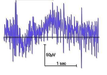 Ηλεκτροεγκεφαλογράφημα (EEG) Θόρυβος