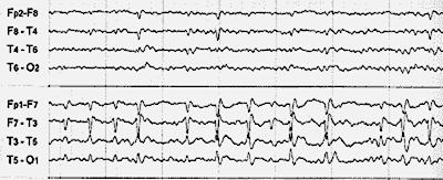 Ηλεκτροεγκεφαλογράφημα (EEG) Το ΗΕΓ μπορεί να διαγνώσει επιληψία