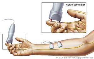 Μελέτες Νευρικής Αγωγιμότητας (Nerve Conduction) Απόκριση περιφερικών νεύρων σε εξωκυτταρικά πεδία Διέγερση σε ένα ή περισσότερα σημεία Μέτρηση των δυναμικών σε συγκεκριμένη απόσταση Μέτρηση της