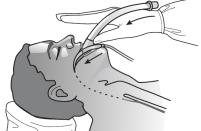 - Διασφαλίστε ότι η αναισθησία είναι επαρκής για το επίπεδο της χειρουργικής διέγερσης προκειμένου να αποφύγετε αντανακλαστικό του εμέτου, βήχα και λαρυγγόσπασμο που οδηγούν σε εκτόπιση της μάσκας