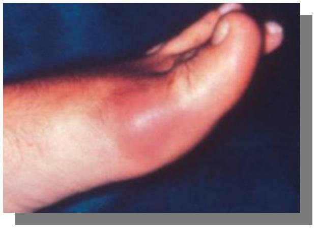 Οξεία ουρική αρθρίτιδα 2 Mονοαρθρίτιδα (85-95%) κάτω άκρων.