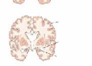 Σε κυτταρικό επίπεδο, χαρακτηριστική είναι η εκτεταμένη συσσώρευση αμυλοειδούς στον εγκέφαλο σε σχηματισμούς που ονομάζονται αμυλοειδικές πλάκες (amyloid plaques) (Εικόνες 1,2).