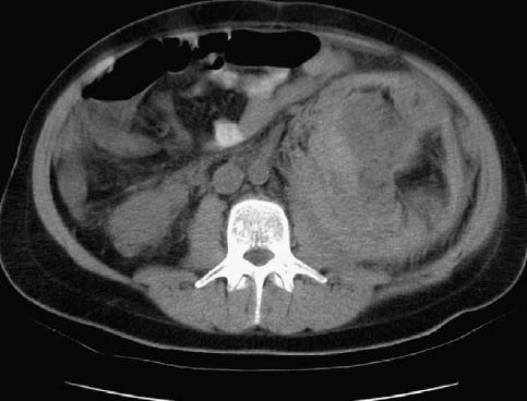 διαφοροποίηση (perivascular epithelioid