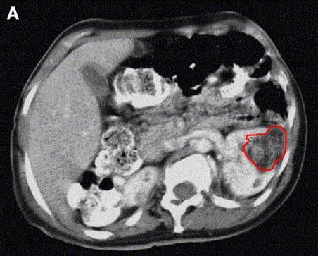 Angiomyolipomata in Patients