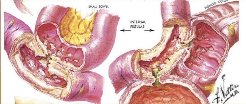 Terapia biologică TNF alfa 1968-1984 Anti TNF 1991 Anti JAK/STAT 1998 AntiIntegrină Anti