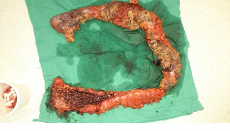 COLITA ULCERATIVĂ CU BOALA CROHN BC Boli cronice intestinale