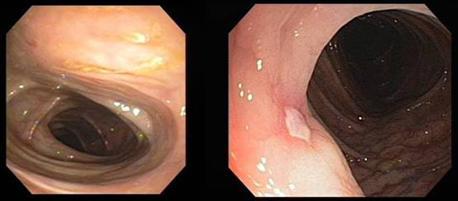 BOALA CROHN Afectarea