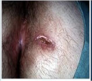 abdominale Malabsorbție Boală