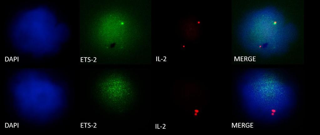 Eικόνα 24: Συνεντοπισμός της πρωτεΐνης Ets-2 και της ARRE2 αλληλουχίας του γονιδίου της IL-2 στην Jurkat κυτταρική σειρά με την χρήση Immuno-DNA FISH.