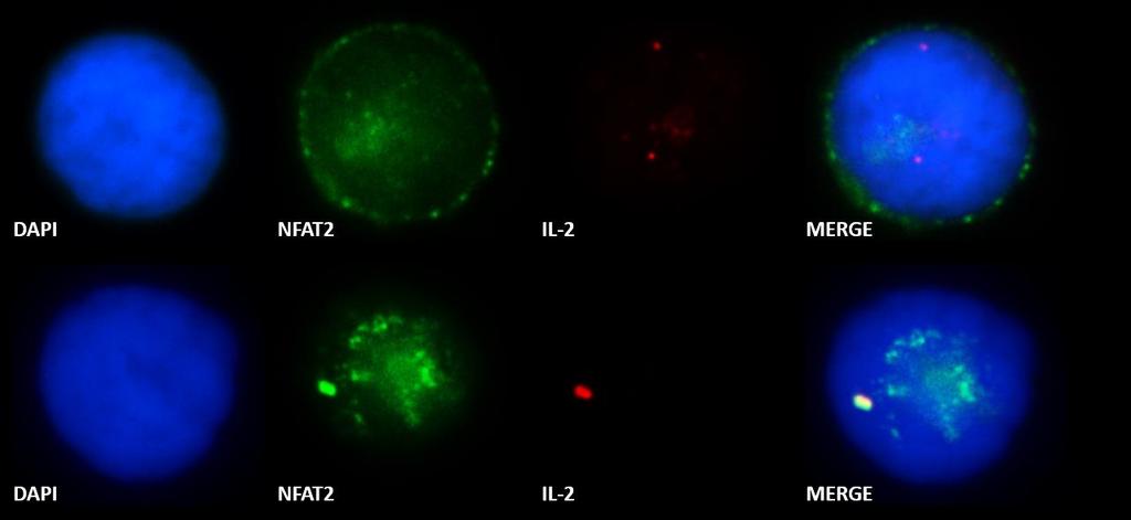 Eικόνα 25: Συνεντοπισμός της πρωτεΐνης NFAT2 και της ARRE2 αλληλουχίας του γονιδίου της IL-2 στην Jurkat κυτταρική σειρά με την χρήση Immuno-DNA FISH.