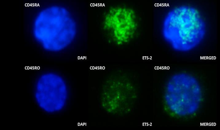 Αυτό που παρατηρούμε από την παραπάνω εικόνα είναι ότι η έκφραση του Ets- 2 μειώνεται σε σημαντικό βαθμό στα παρθενικά Τ κύτταρα των ασθενών με Σκλήρυνση κατά πλάκας σε σχέση με τα αντίστοιχα κύτταρα