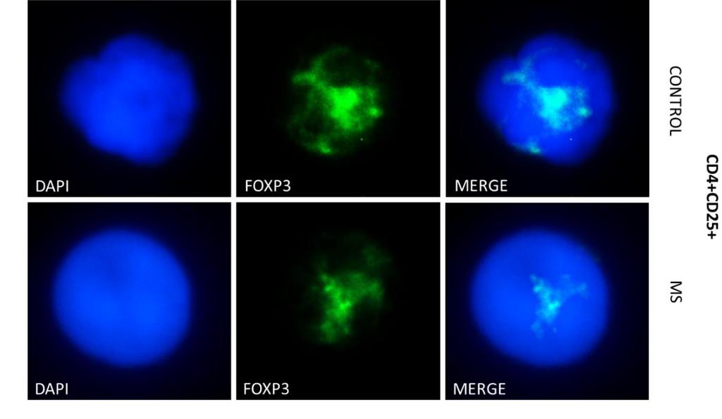 Αυτό που παρατηρήσαμε είναι μειωμένη έκφραση του FoxP3 στα Τ ρυθμιστικά κύτταρα ασθενών σε ύφεση σε σχέση με τα κύτταρα των υγιών δοτών.