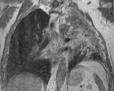 3 ο Περιστατικό MRI Θώρακος 08/10/2013 Ατελεκτασία ΑΑΛ µε συµπαγείς