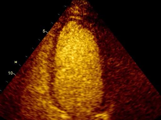 Echocardiography Contrast can help improve endocardial border definition to levels compatible with CMR.