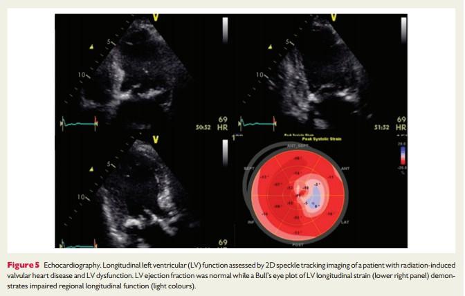 Speckle-tracking echocardiography In contrast to